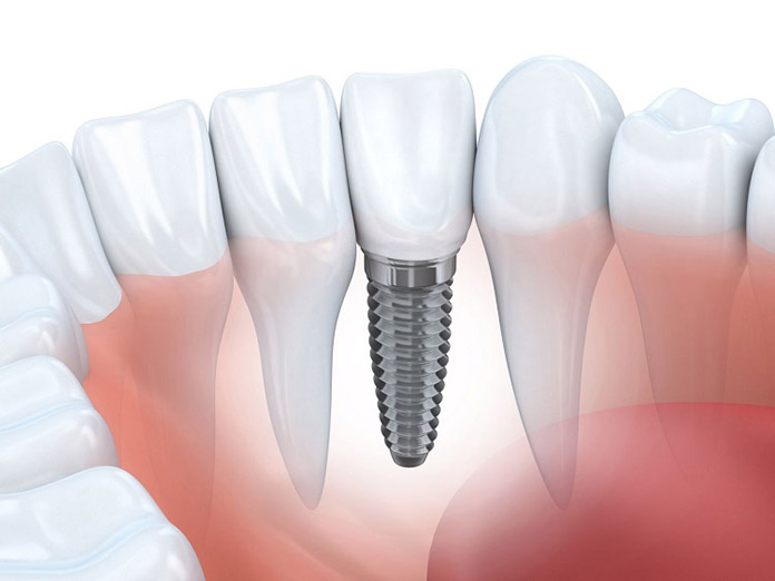 Top 13 địa chỉ trồng răng implant tại TPHCM tốt nhất | Image: Jes.edu.vn