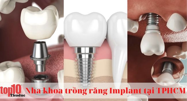 Danh sách nha khoa trồng răng Implant tại TPHCM uy tín, chuyên nghiệp