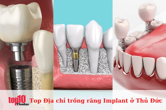 Top 13 Địa chỉ trồng răng Implant ở Thủ Đức uy tín, tốt nhất