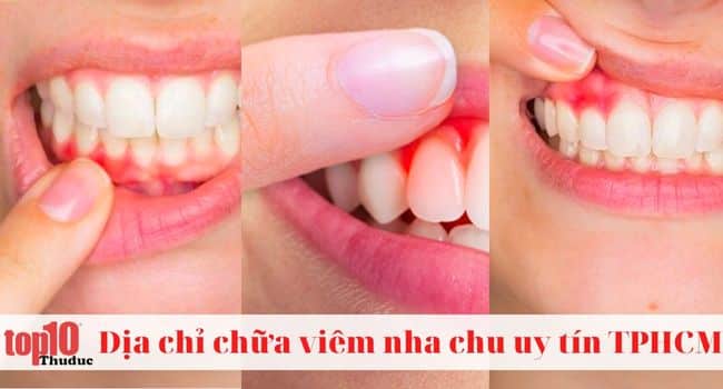 Top 15 Địa chỉ chữa viêm nha chu ở TPHCM an toàn, hiệu quả