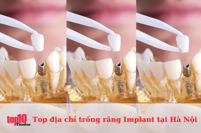 Top 18 địa chỉ trồng răng Implant Hà Nội uy tín, tốt nhất