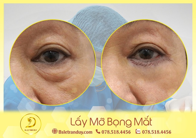 Lấy mỡ bọng mắt đẹp tự nhiên, được rất đông khách hàng tìm đến bác sĩ Lê Trần Duy để thực hiện