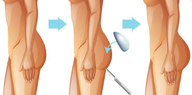 Mô phỏng quá trình nâng mông